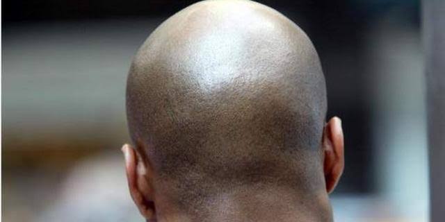 New Study Shows Energy Drinks May Lead To Baldness In Men