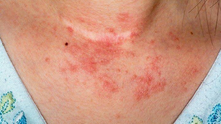 How Close A Person Lives To A Major Road Increases Their Risk Of Developing Eczema, A New Study Finds