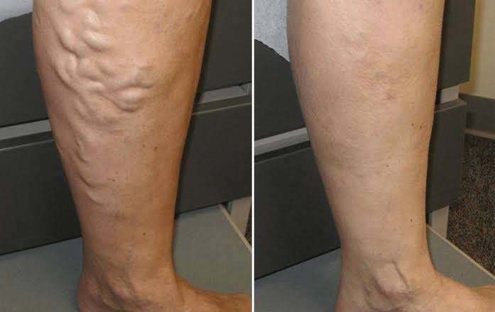 5 Simple Things Spider Veins Are Telling You To Do