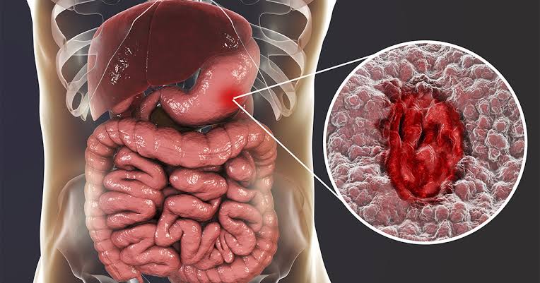 6 Major Symptoms Of Stomach Ulcer