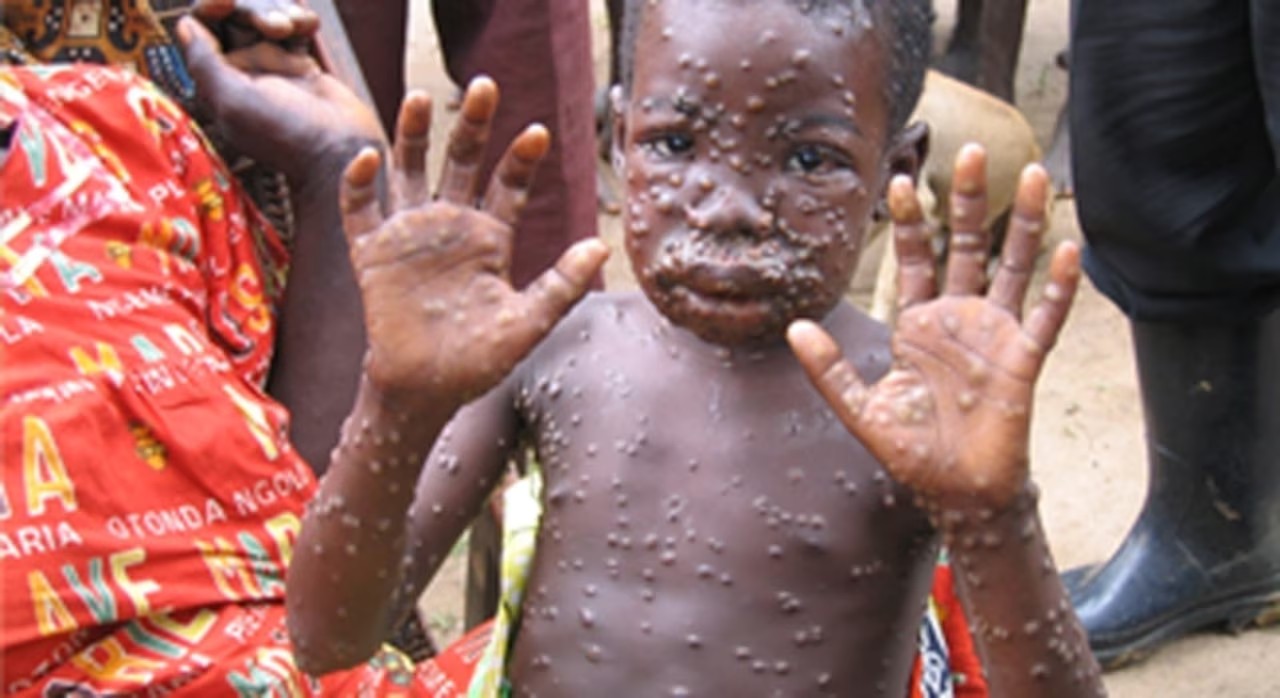 Mpox Vaccination In Malawi To Target Only High-Risk Individuals, Says Health Ministry